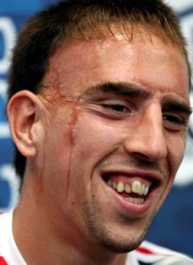 Franck Ribéry moche